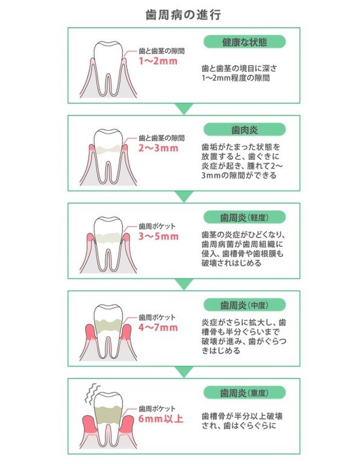 歯周ポケットの深さで歯周病の進行具合をチェック!