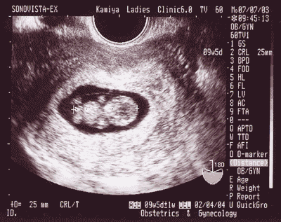 超音波写真の数字で読み取る 赤ちゃんの成長ぶり