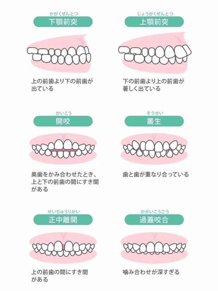 ⑤歯列（歯並び）・咬合（噛み合せ）の判定