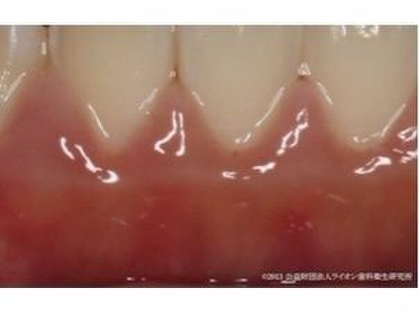 ②歯肉(歯茎)の判定