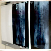 シリカの効能 骨粗しょう症の予防効果が!?