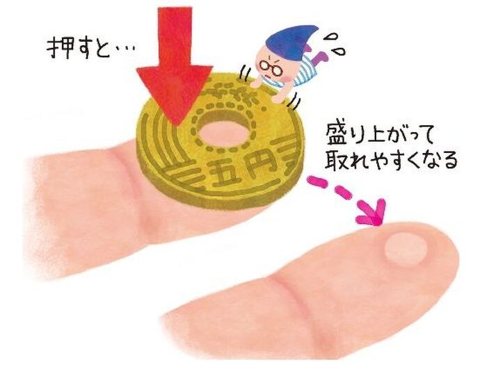 トゲが刺さったときは5円玉と梅干し