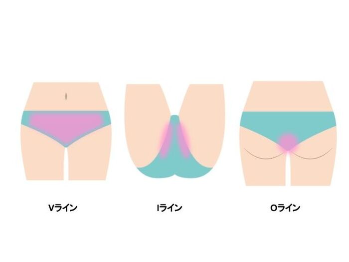 VIO脱毛とは?ハイジニーナって?