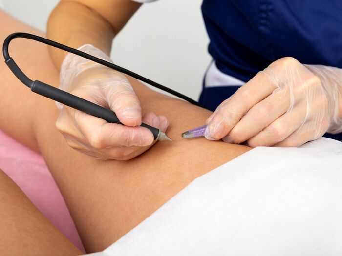 VIOラインの白髪を脱毛する方法1:ニードル脱毛