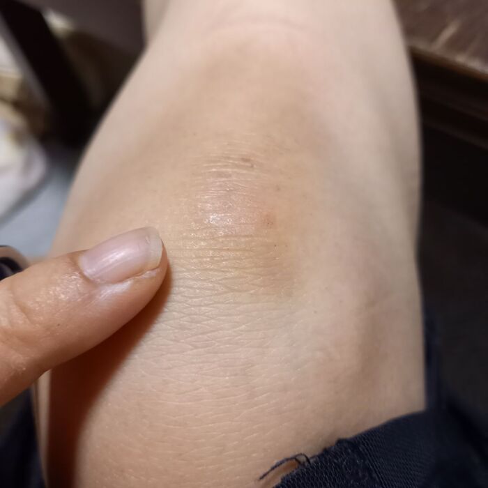 膝にできた角質を取る❗