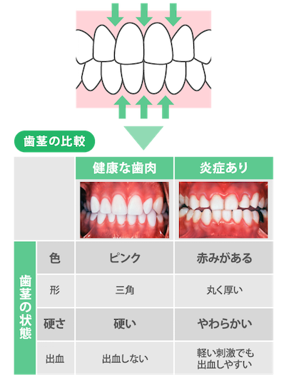 早めに気づいて予防を 歯周病のセルフチェックの方法と対策 暮らしニスタ