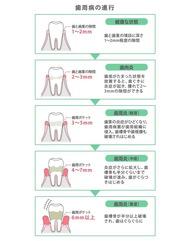 歯周ポケットの深さで歯周病の進行具合をチェック！