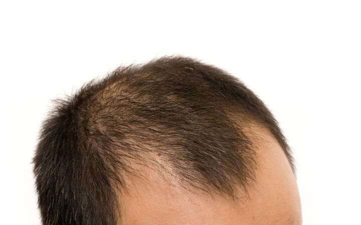 髪は無くとも愛はある♡「ヅラをつけたい」と言う夫に、妻としてどう答えますか?