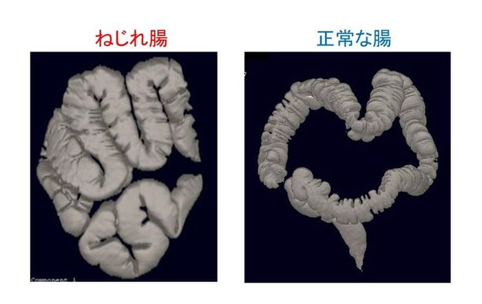 え なにそれ 便秘の原因は ねじれ腸 や 落下腸 かも まずはセルフチェックを 暮らしニスタ Goo ニュース え なにそれ 便秘の原因は ねじれ腸 や 落下腸 かも まずはセルフチェックを 暮らしニスタ Goo ニュース