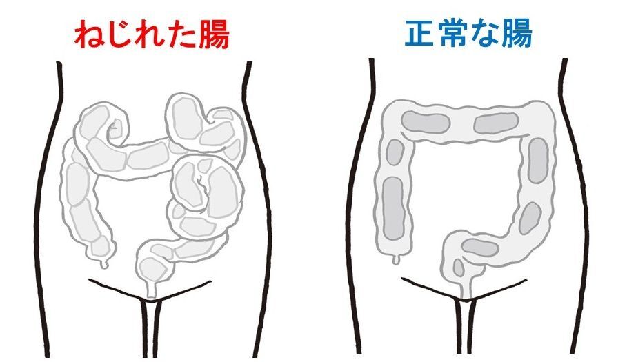 え、なにそれ？便秘の原因は「ねじれ腸」や「落下腸」かも！まずは